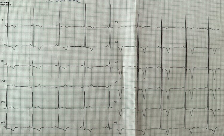 Диффузные изменения миокарда ответы врачей. Высокий Вольтаж ЭКГ. Гипертрофия кардиомиопатия ЭКГ. Низкий Вольтаж на ЭКГ. ЭКГ при кардиомиопатиях.